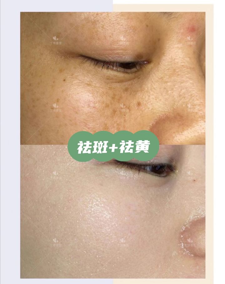 40岁去皱纹眼袋有效果吗,37岁眼袋有皱纹能去掉吗