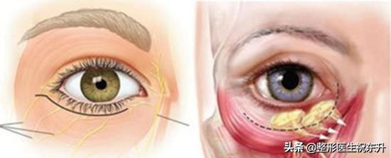 面部提拉可以改善泪沟嘛,做完面部提升手术