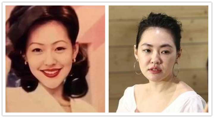 如何改善咬肌鹅蛋脸,咬肌变大脸发腮怎么改善