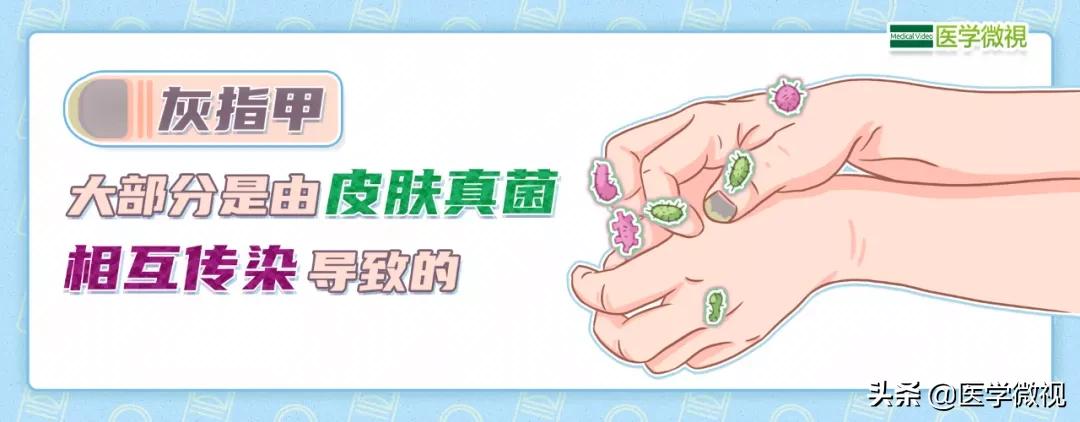 灰指甲治了半年也没治好？可能不是药的问题