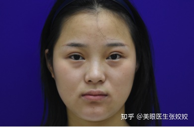 有没有割过眼袋后悔的,肿眼泡割双眼皮后悔率