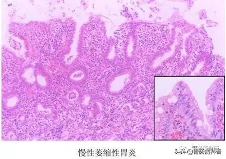 胃肠镜活检结果一般都是什么结果,肠镜和肠镜活检