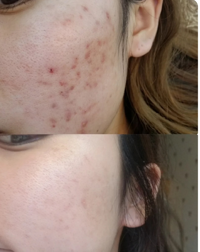 雅漾祛痘精华祛痘效果怎么样,护肤品推荐祛痘控油