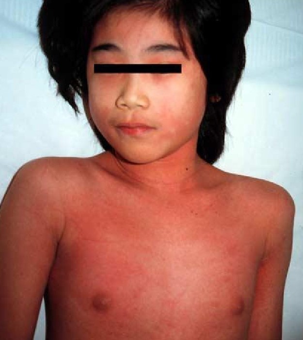 猩红热是疹子先出现还是发烧,猩红热出疹子后体温低烧