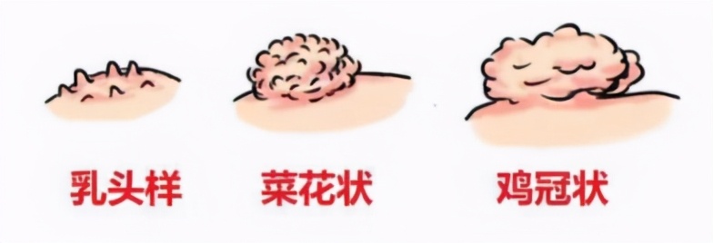 都安全小黄盒|感染了HPV，是X病吗？专家告诉你真相