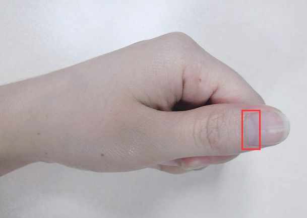 指甲上月牙少是什么问题,指甲月牙少了怎么回事