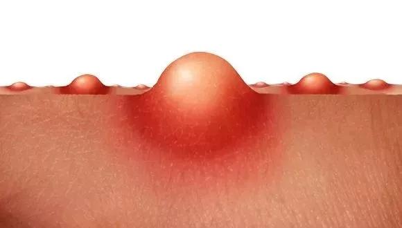 看懂各种痘痘类型和应对方法,一分钟教你分辨痘痘类型