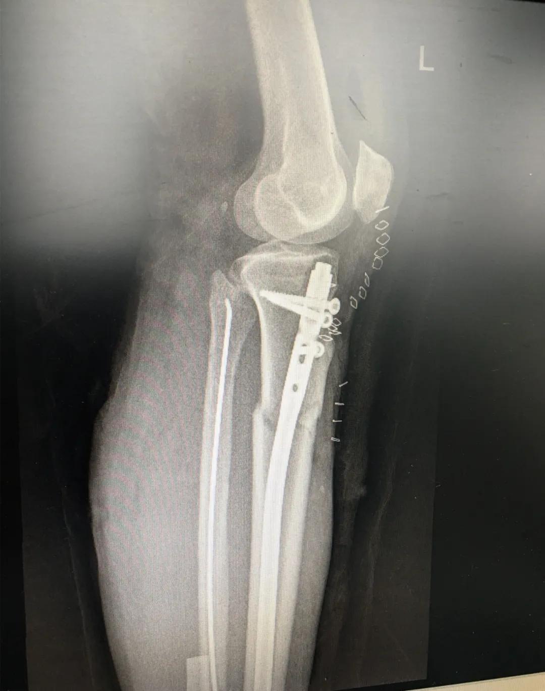 小腿骨断成三截了还能恢复吗,小腿断了三截能好彻底吗