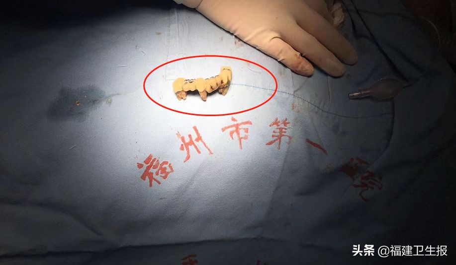 老人误吞假牙,大爷误吞两颗假牙