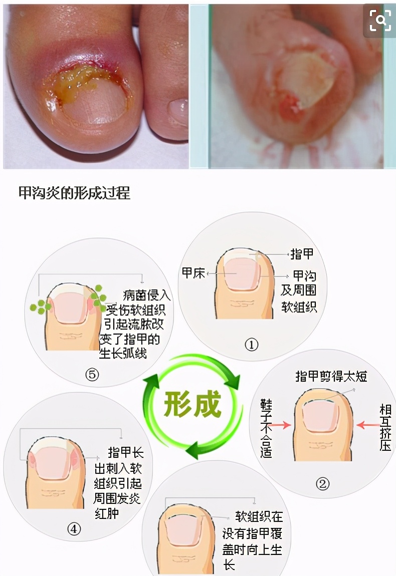 甲沟炎好治吗是什么原因引起的,甲沟炎特别严重的情况下怎么办