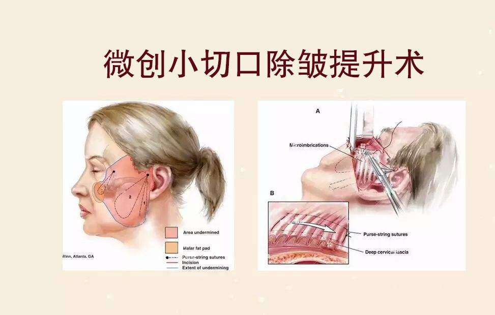 小拉皮和线雕哪个抗衰老效果好,最厉害的拉皮抗衰老技术