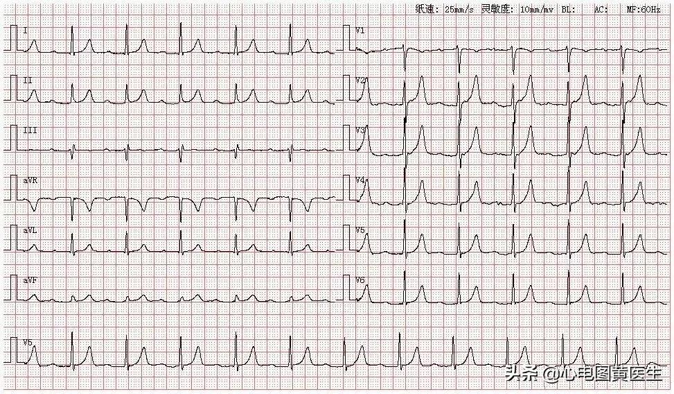 一度房室传导阻滞可以剧烈运动吗,一度房室传导阻滞是心脏病吗