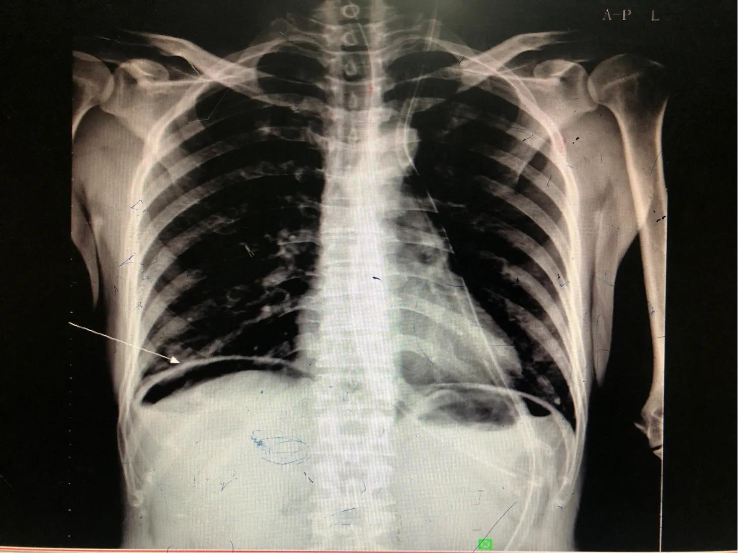 消化道穿孔会腹痛怎么办,肚子痛消化道穿孔