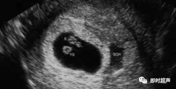 胚胎停育hcg还是升高吗,胚胎停育综述