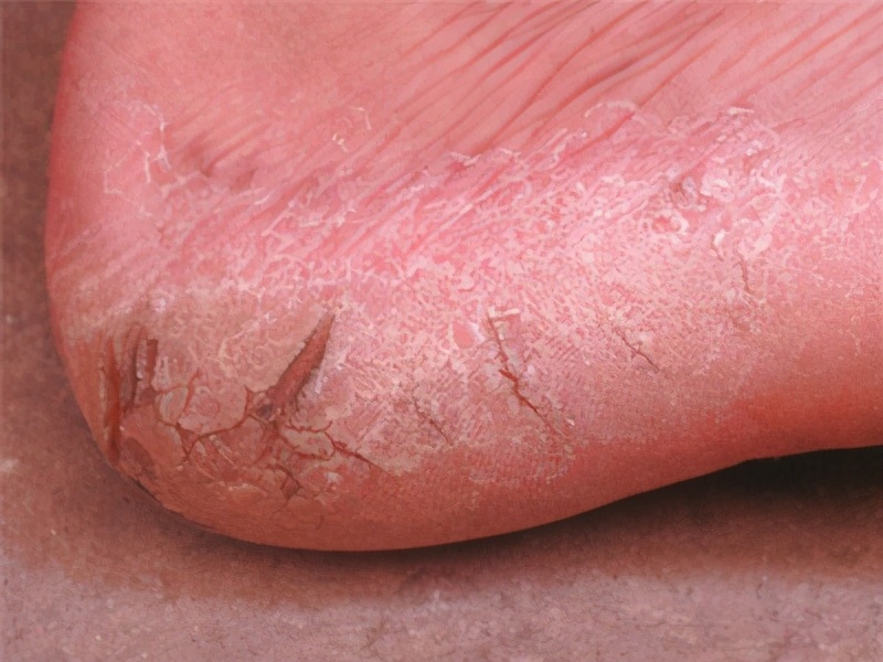 脚气反复奇痒无比,脚气引起全身痒怎么治