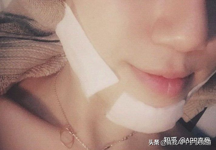 敏感肌肤满脸闭口可以刷酸吗,脸上好多闭口粉刺很敏感怎么办