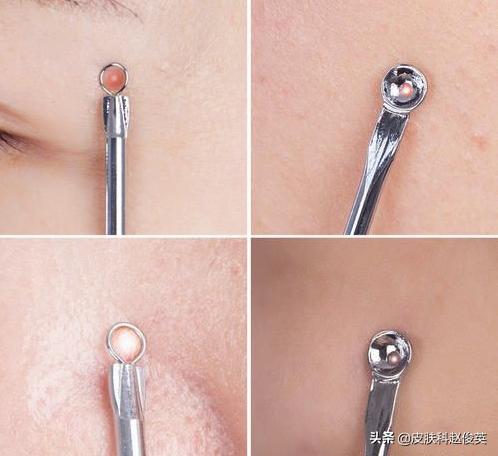 黑头怎样从内部调理,挤黑头和吸黑头哪个对毛孔损伤大