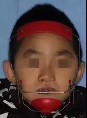 地包天早期矫正最佳时间,地包天10-15岁矫正是最佳年龄吗