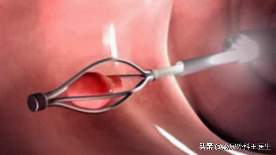 男性做了结扎要注意什么,男性做了结扎会自动复原吗