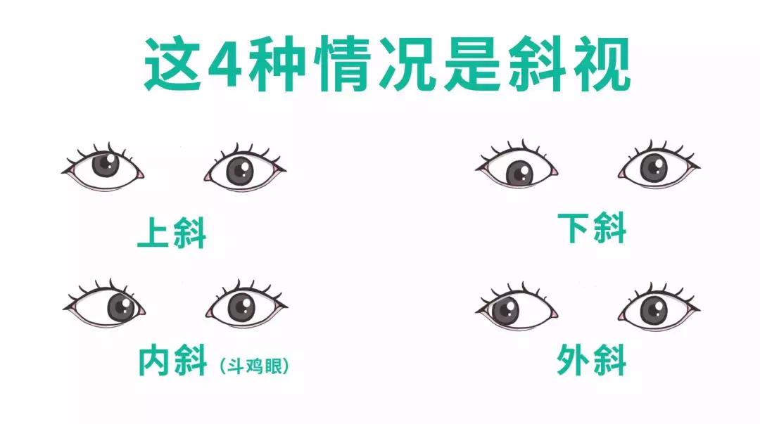 眼睛斜视和斜视检查有什么区别,斜视弱视可以做斜视手术吗