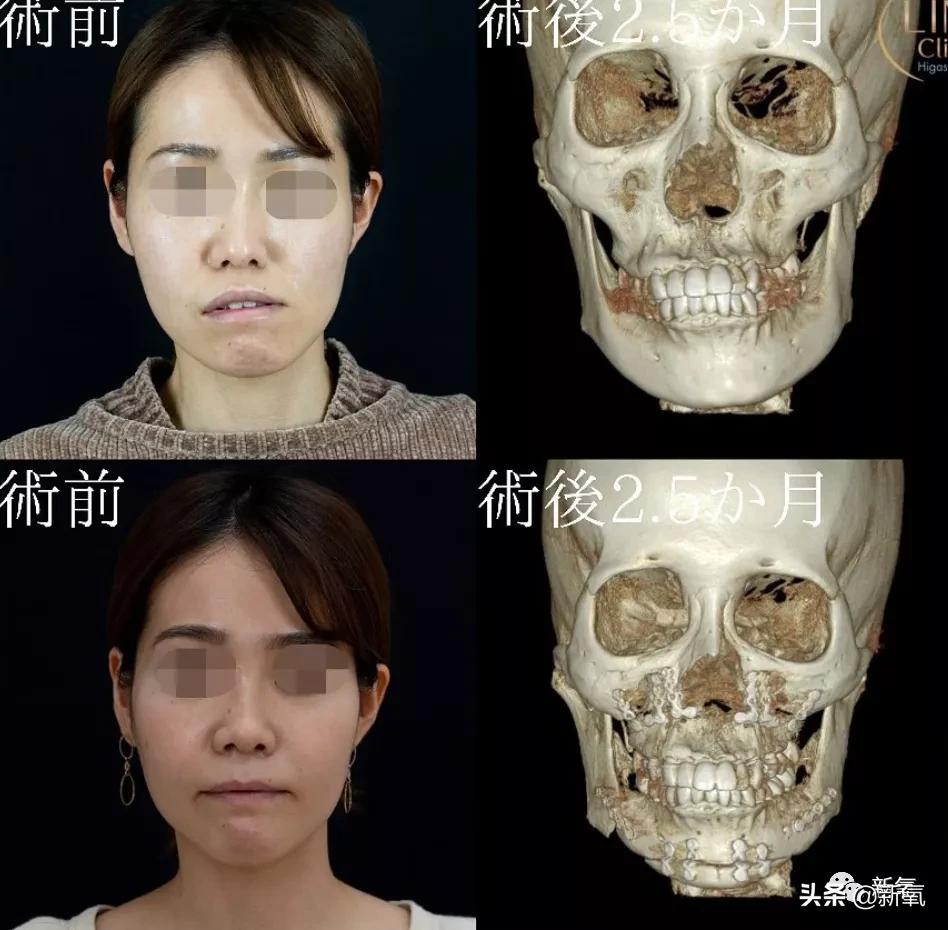 大小脸不对称怎么改变,大小脸不对称改善动作