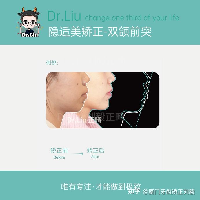 下嘴唇厚且外翻牙齿矫正,深覆合牙齿矫正嘴凸