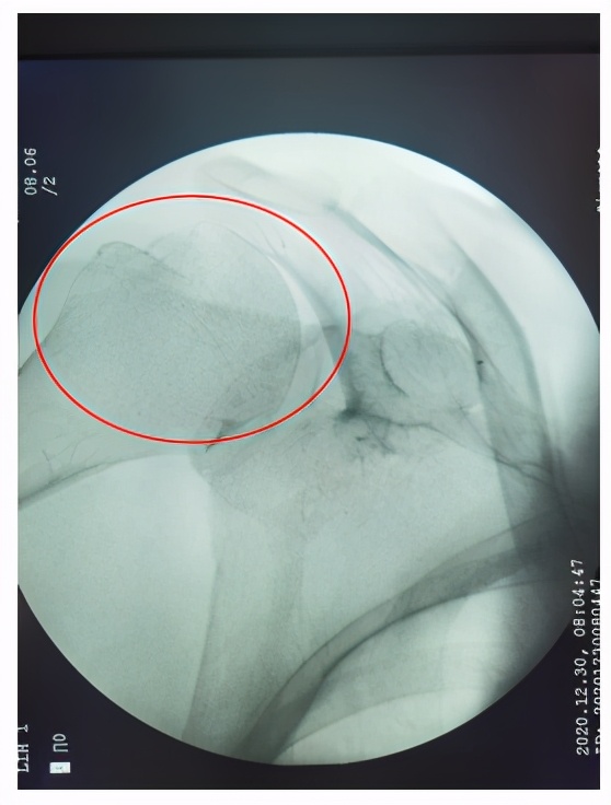 摔倒手掌撑地肩关节会脱位吗,老人摔倒胳膊脱位