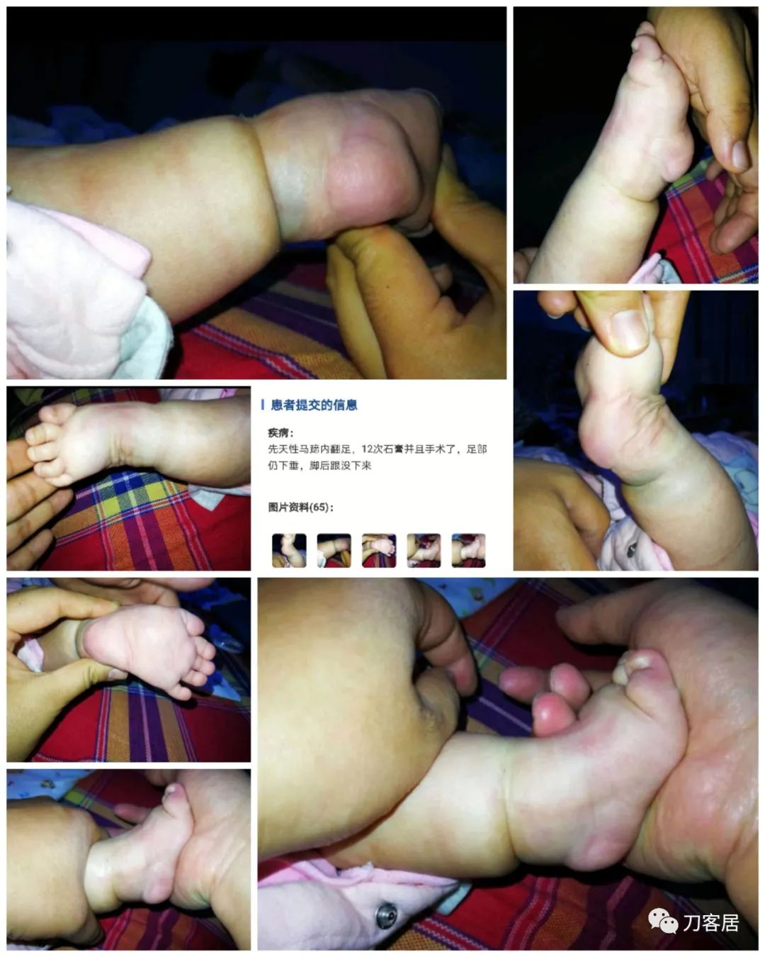 一个脊柱外科医生与马蹄内翻足的纠缠-写在6.3国际马蹄内翻足日前