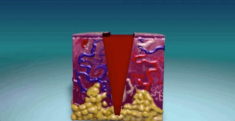 怎么恢复愈合伤口留下的疤痕,科普短片伤口是如何愈合的