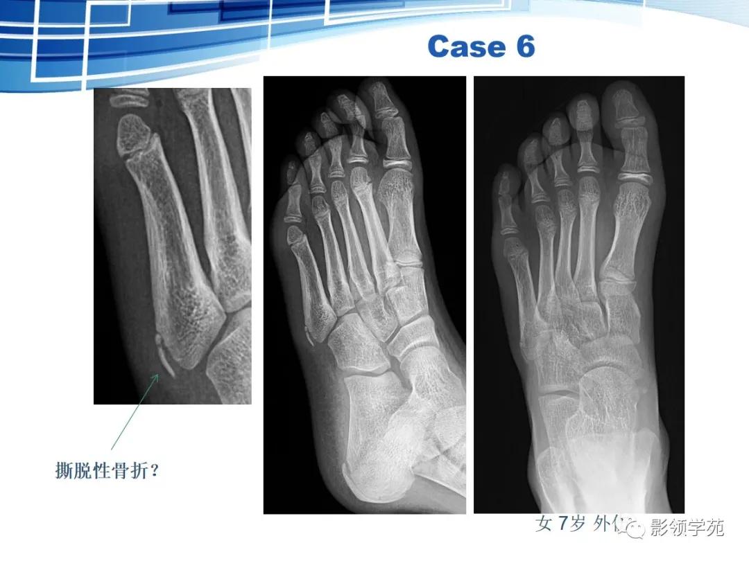 桡骨远端骨折引起尺骨变异,撕脱骨折一个月无明显骨痂形成
