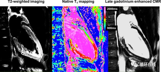 「彤心飞传」ST段广泛抬高伴QTc间期延长--临床诊断？