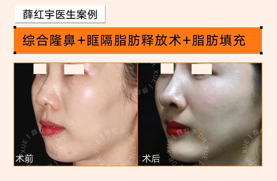 自体脂肪移植后的图片,自体脂肪移植丰胸丰臀