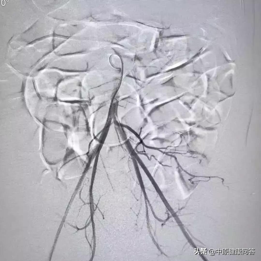 6个月女婴被侵犯后续,婴儿右侧腰部血管瘤