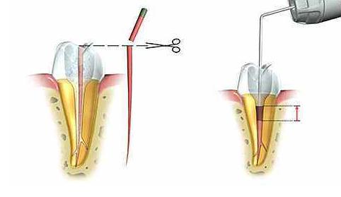 i型根管如何预备和充填,根管预备后可以直接充填吗