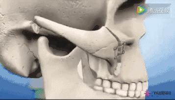 高颧骨脸颊凹妆容,高颧骨有办法改善吗