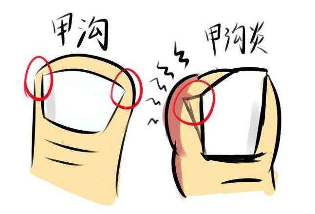 脚趾甲嵌进肉里面原因,脚趾甲长肉里拔不出来怎么办