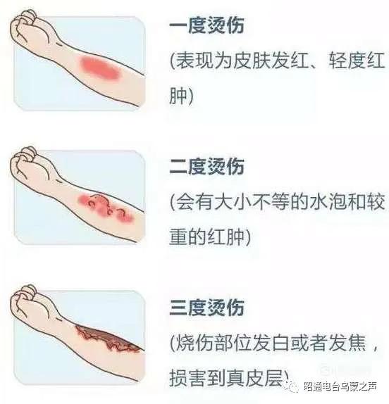 贵阳凹陷烫伤疤痕怎么修复,烧烫伤疤痕增生凸起怎么治