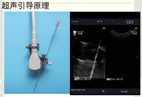 卵巢囊肿手术是把囊肿刺破吗,卵巢囊肿超过5cm需要什么治疗手段