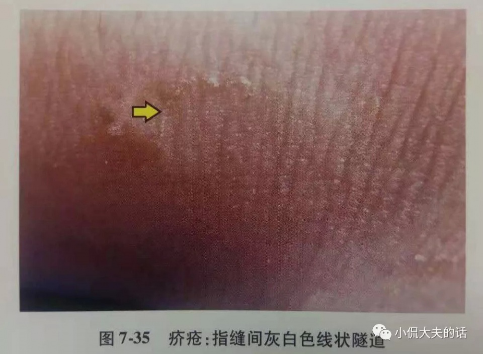 得了疥疮可以吃猪肉吗,大猪身上长癣怎么治用什么药