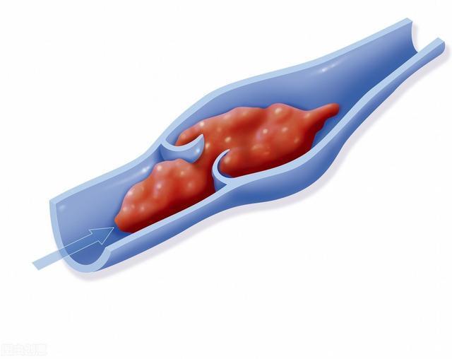 血栓脱落造成下肢肿胀能治愈吗,下肢发生血栓会有哪些症状
