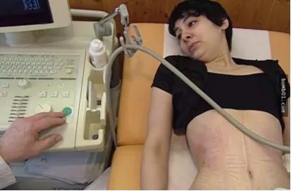 内脏下垂漏尿,戴束腰内脏下垂