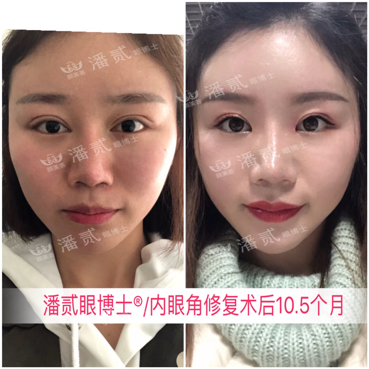 开内眼角会留疤的照片,开内眼角的疤痕变白色了怎么办