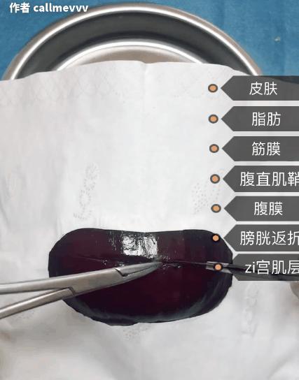 香蕉割包皮，洋葱剖腹产？这是我见过最秀的医生