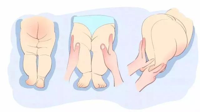 宝宝大腿纹不对称，要做哪些检查？