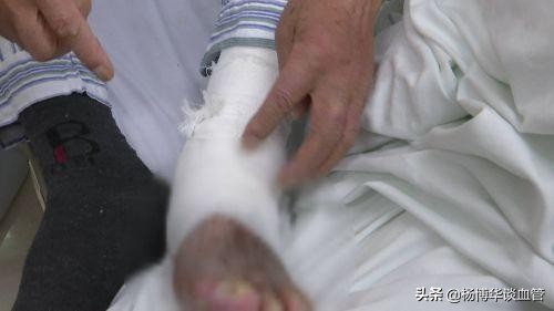 静脉血栓不必要制动怎么理解,静脉血栓用不用去滤网