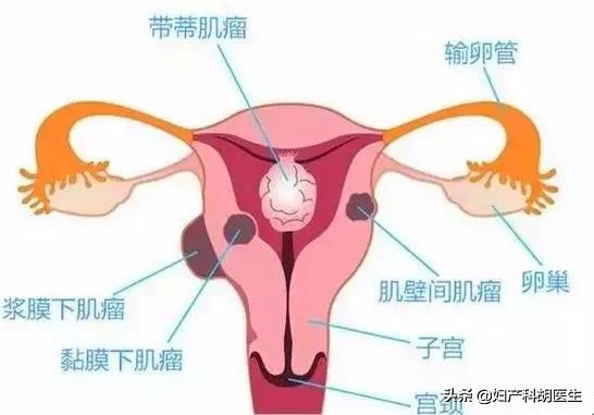 怀孕三个月肌瘤5厘米了,怀孕了发现有肌瘤怎么办