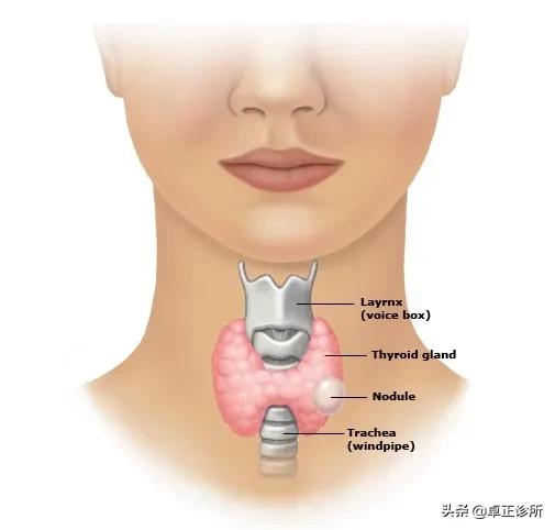 体检发现甲状腺结节怎么办啊,体检发现甲状腺结节怎么办