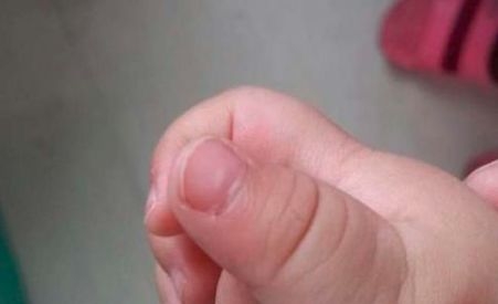 手上出现白点是什么原因造成的,宝宝手上的小白点