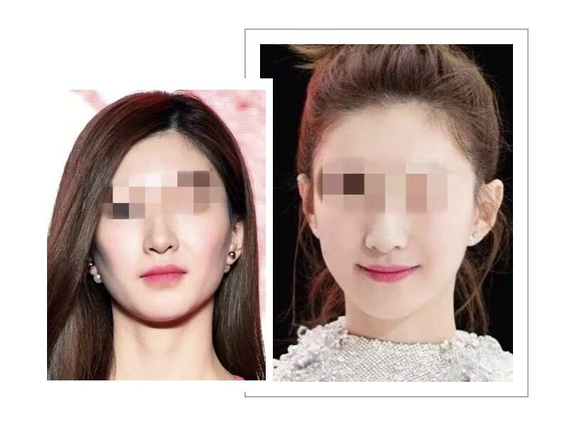 解密瘦脸针的几大常识性问题,关于瘦脸针的几个常识问题