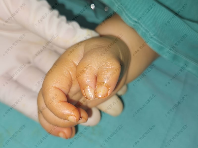 婴儿手指多指畸形有8个,婴儿手指多指是不是母体原因
